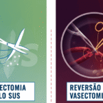 Vasectomia Pelo SUS